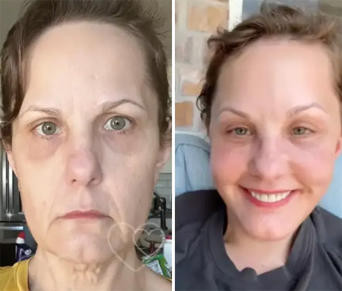 Woman Shows Her Crazy Transformation, People Can’t Believe It: “Lip Fillers, Botox, Weight Loss”