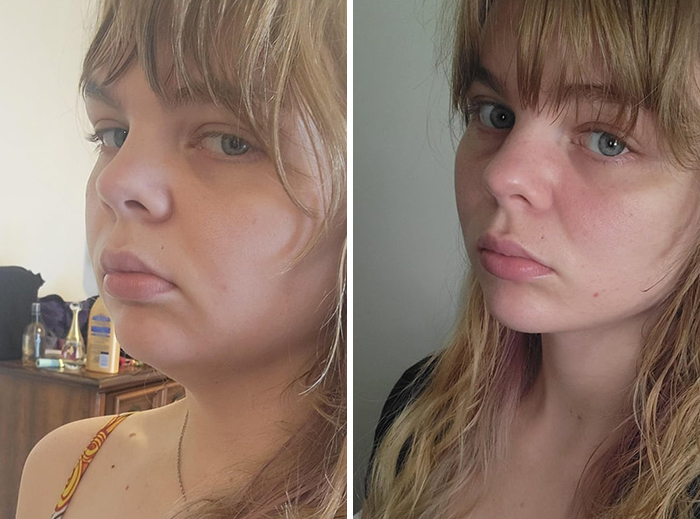 Woman Shows Her Crazy Transformation, People Can’t Believe It: “Lip Fillers, Botox, Weight Loss”