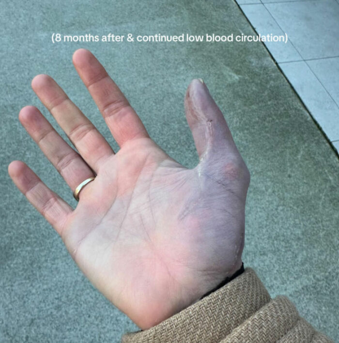 Young Woman Issues Urgent Warning About Going To Nail Salons After She Ended Up In The Hospital