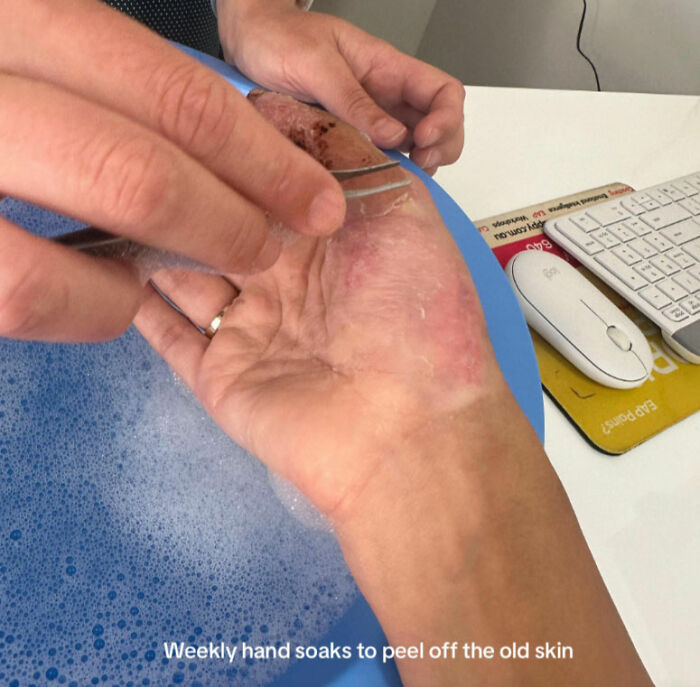 Young Woman Issues Urgent Warning About Going To Nail Salons After She Ended Up In The Hospital