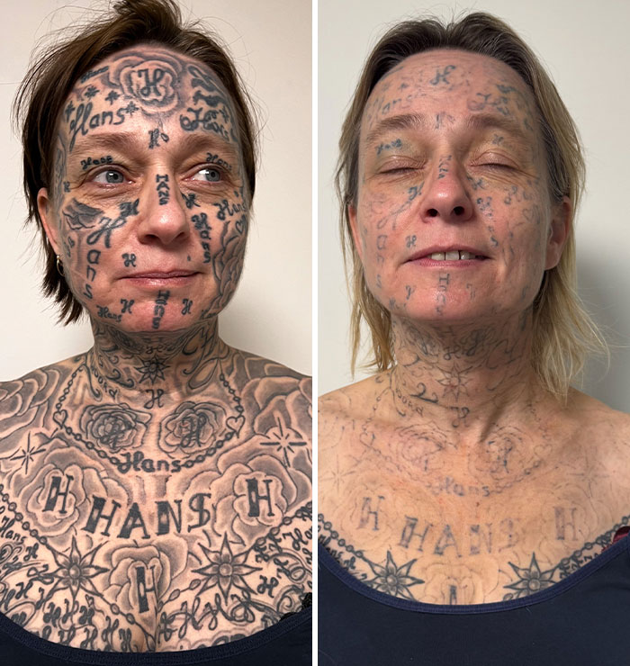After Partner Forced 250 Tattoos Of His Name Onto Her, 52YO Woman’s Tattoo Removal Transformation Stuns