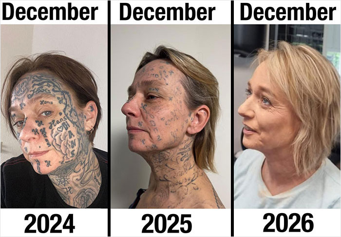 After Partner Forced 250 Tattoos Of His Name Onto Her, 52YO Woman’s Tattoo Removal Transformation Stuns