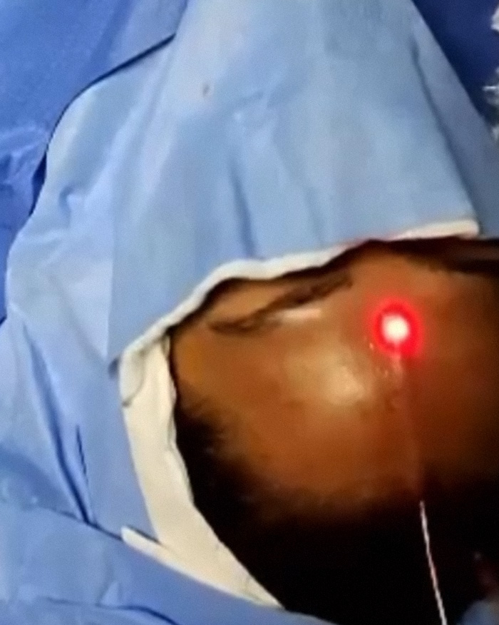 This Influencer Removed A Vein From Her Forehead Because It Bothered Her Aesthetically And Shared The Results