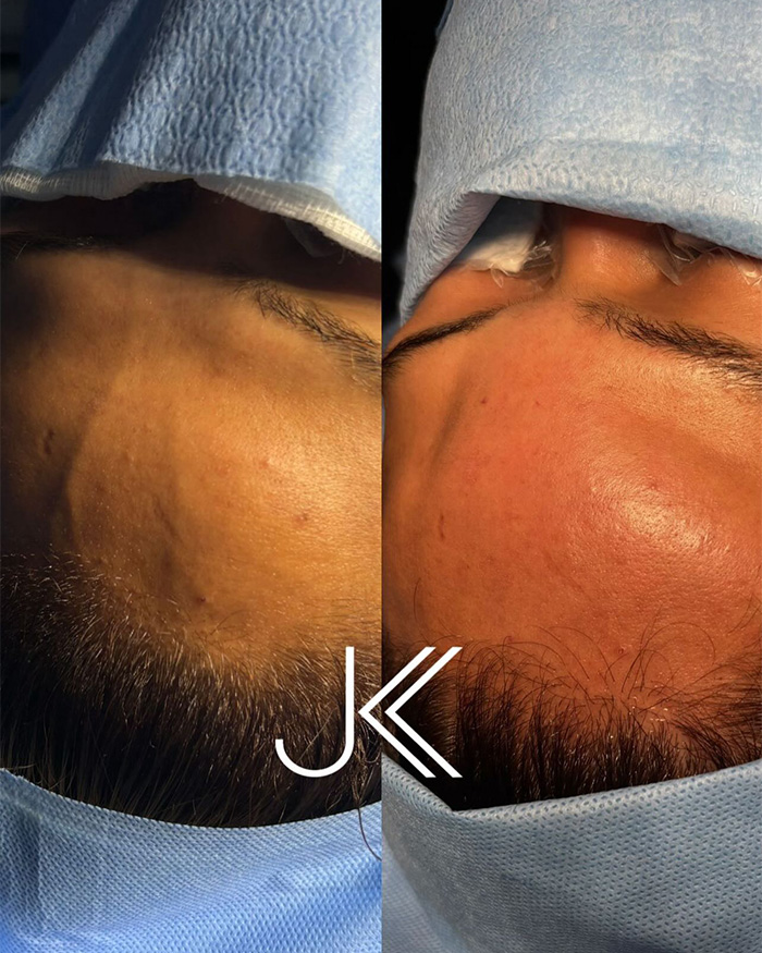 This Influencer Removed A Vein From Her Forehead Because It Bothered Her Aesthetically And Shared The Results