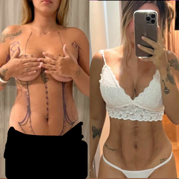 “Puts Things Into Perspective”: Influencer Reveals The Botched Plastic Surgery She Had Been Hiding With Photoshop For Years