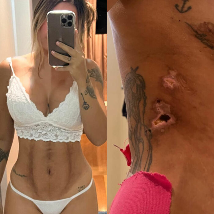 “Puts Things Into Perspective”: Influencer Reveals The Botched Plastic Surgery She Had Been Hiding With Photoshop For Years