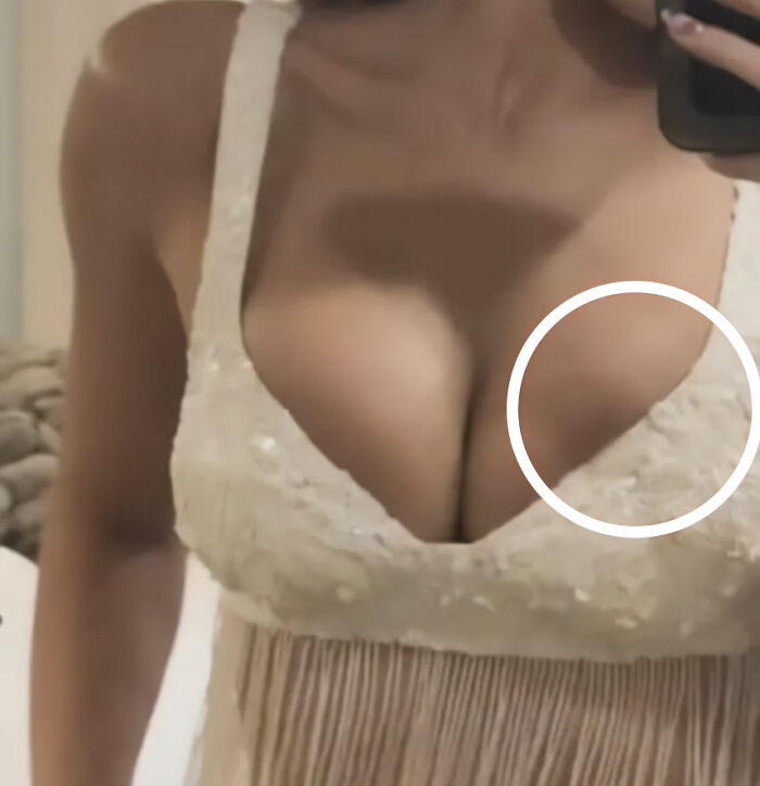 Kylie Jenner Sparks Concern Her Breast Implants Have Ruptured After Fans Notice Detail In Coachella Snap