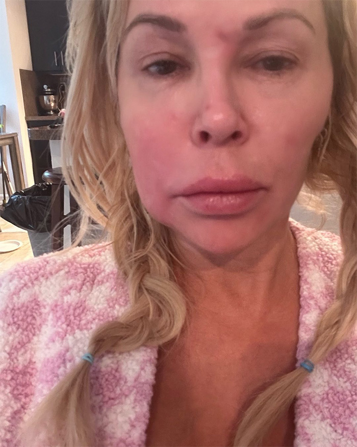 Brandi Glanville Rushed To Urgent Care After Trying Dangerous TikTok Medical Trend
