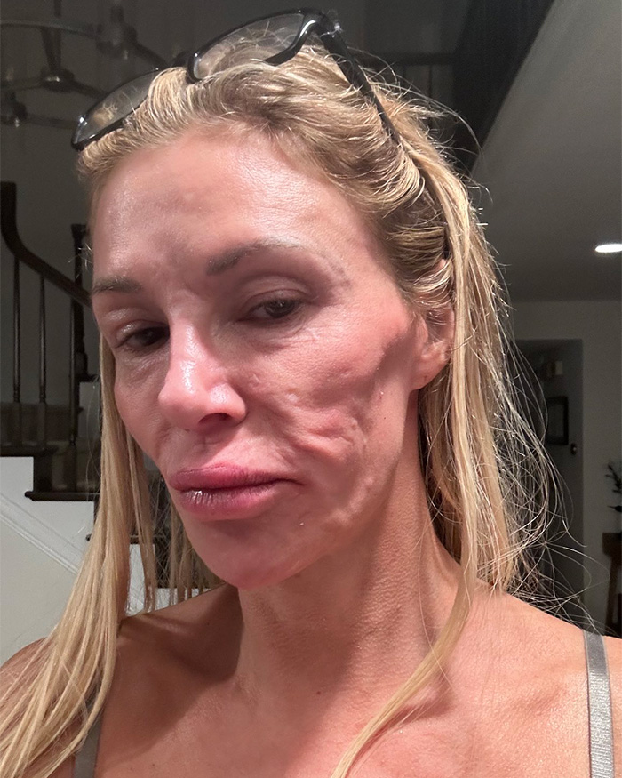 Brandi Glanville Rushed To Urgent Care After Trying Dangerous TikTok Medical Trend
