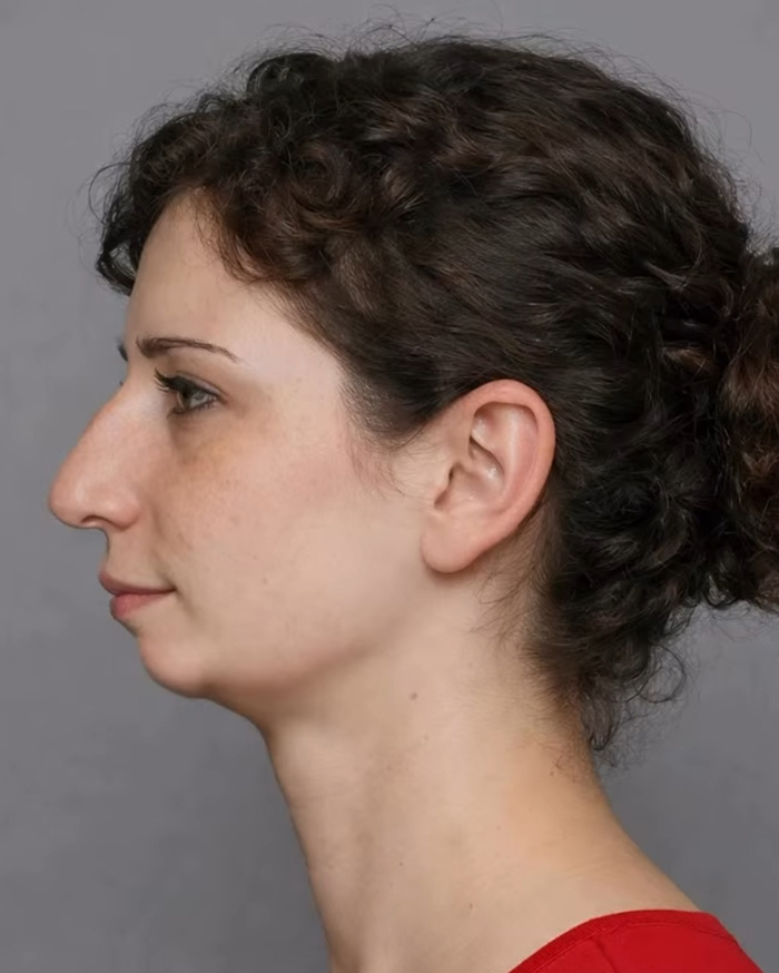 “Best Facial Harmonization I’ve Ever Seen”: 25 Before-And-Afters By A Plastic Surgeon Whose Work Went Viral