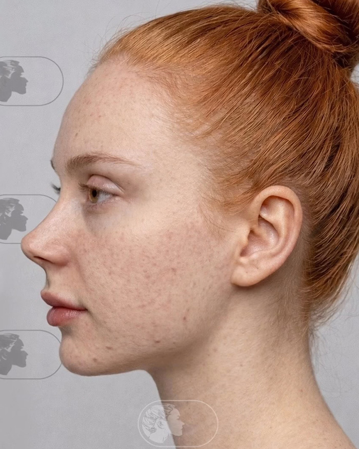 “Best Facial Harmonization I’ve Ever Seen”: 25 Before-And-Afters By A Plastic Surgeon Whose Work Went Viral