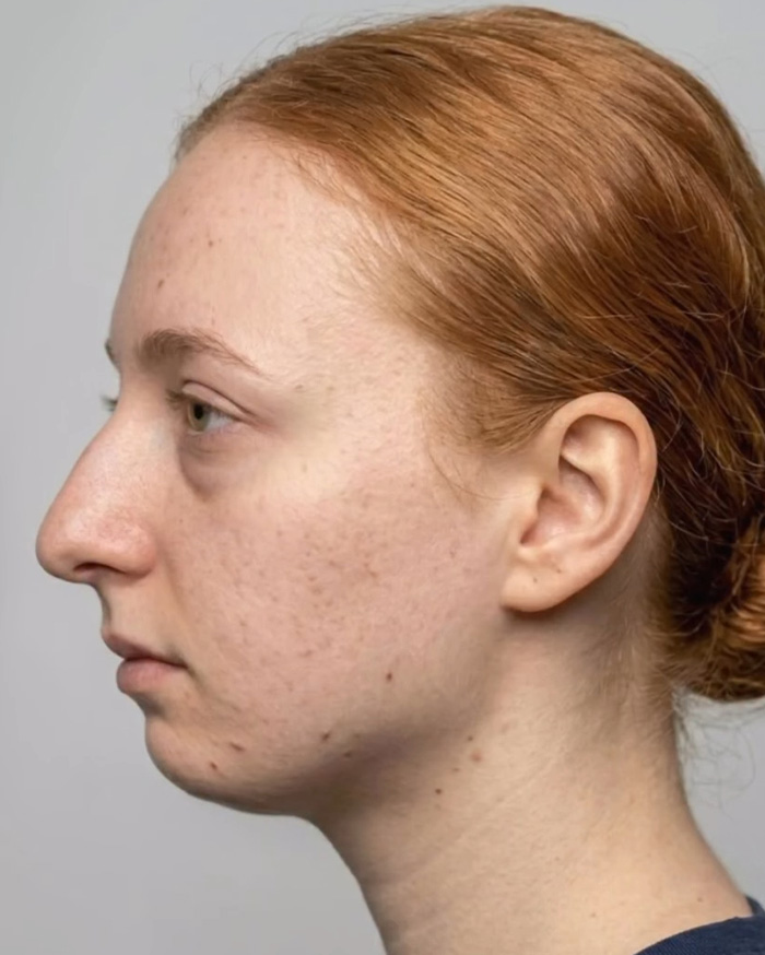 “Best Facial Harmonization I’ve Ever Seen”: 25 Before-And-Afters By A Plastic Surgeon Whose Work Went Viral
