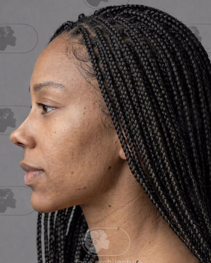 “Best Facial Harmonization I’ve Ever Seen”: 25 Before-And-Afters By A Plastic Surgeon Whose Work Went Viral