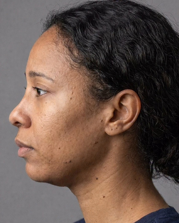 “Best Facial Harmonization I’ve Ever Seen”: 25 Before-And-Afters By A Plastic Surgeon Whose Work Went Viral