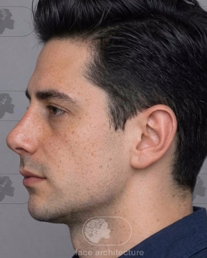 “Best Facial Harmonization I’ve Ever Seen”: 25 Before-And-Afters By A Plastic Surgeon Whose Work Went Viral