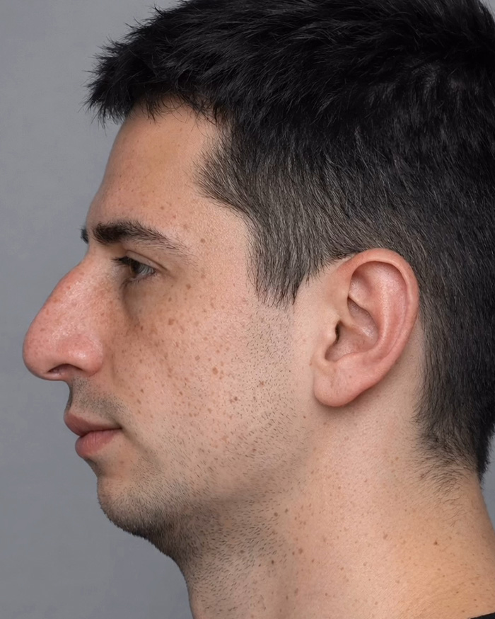 “Best Facial Harmonization I’ve Ever Seen”: 25 Before-And-Afters By A Plastic Surgeon Whose Work Went Viral