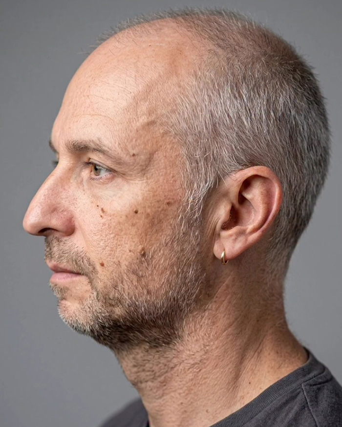 “Best Facial Harmonization I’ve Ever Seen”: 25 Before-And-Afters By A Plastic Surgeon Whose Work Went Viral