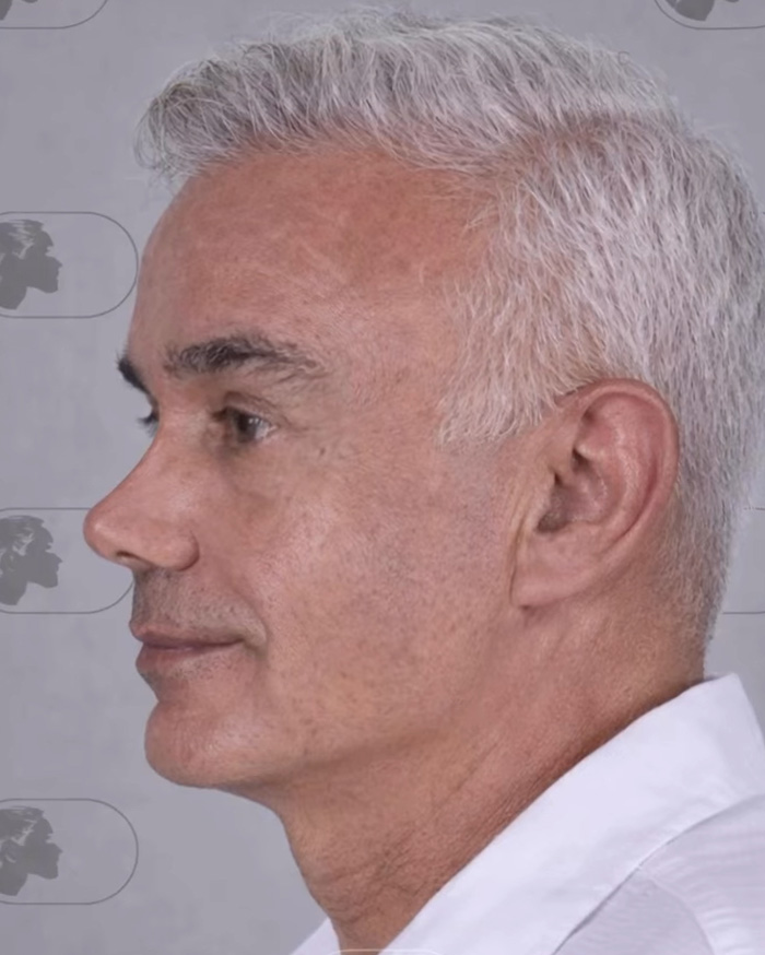 “Best Facial Harmonization I’ve Ever Seen”: 25 Before-And-Afters By A Plastic Surgeon Whose Work Went Viral