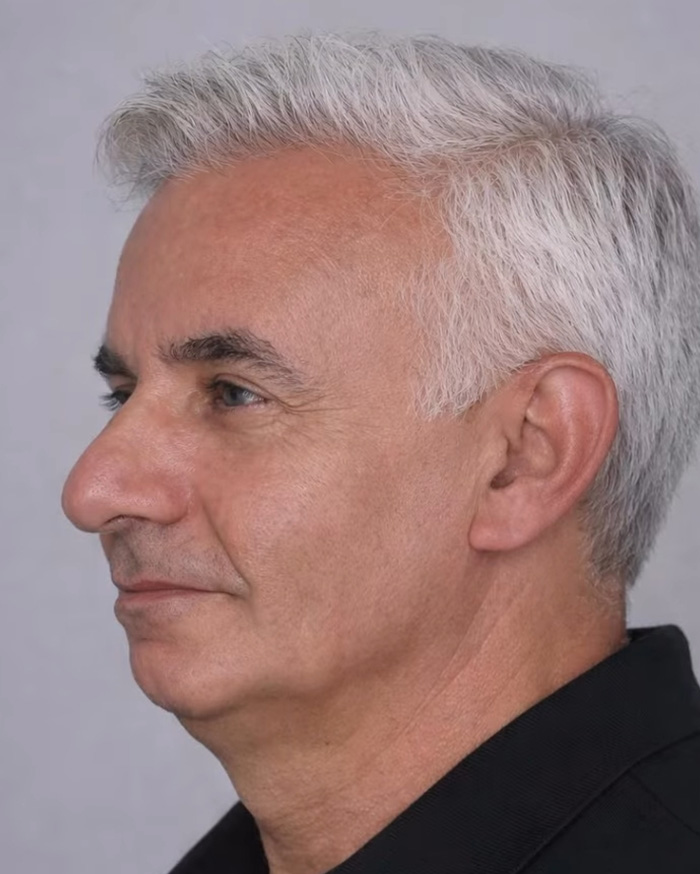 “Best Facial Harmonization I’ve Ever Seen”: 25 Before-And-Afters By A Plastic Surgeon Whose Work Went Viral