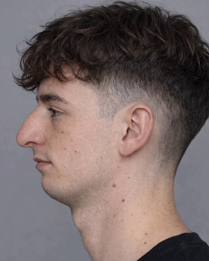 “Best Facial Harmonization I’ve Ever Seen”: 25 Before-And-Afters By A Plastic Surgeon Whose Work Went Viral