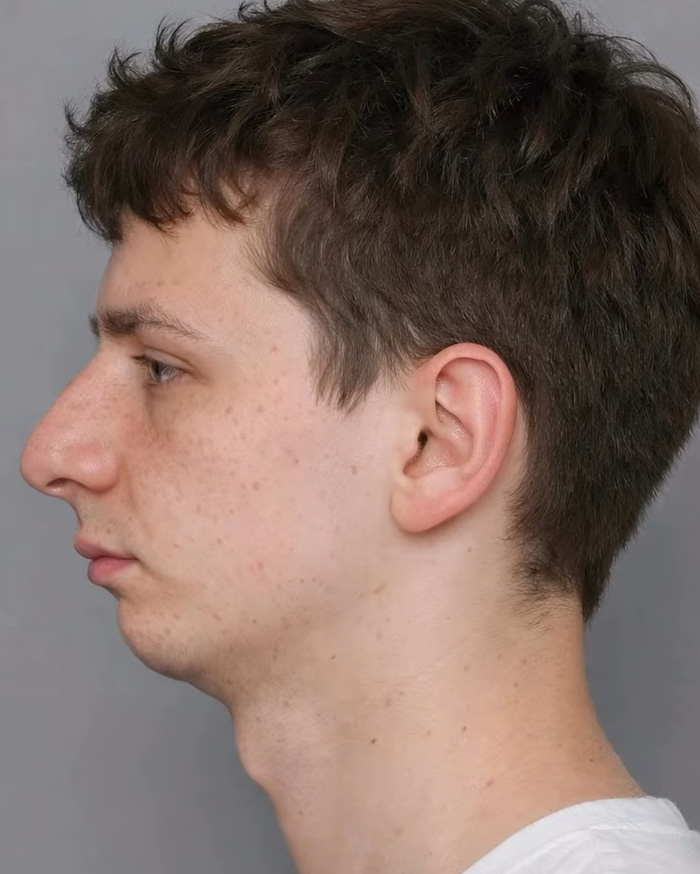 “Best Facial Harmonization I’ve Ever Seen”: 25 Before-And-Afters By A Plastic Surgeon Whose Work Went Viral