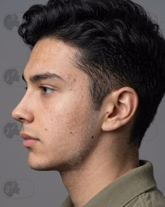 “Best Facial Harmonization I’ve Ever Seen”: 25 Before-And-Afters By A Plastic Surgeon Whose Work Went Viral