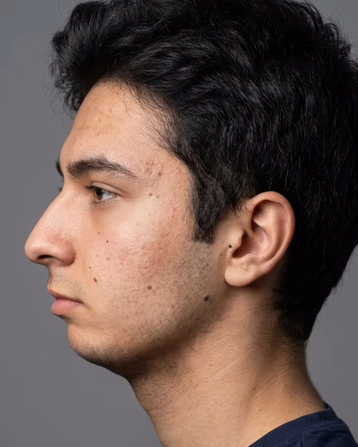 “Best Facial Harmonization I’ve Ever Seen”: 25 Before-And-Afters By A Plastic Surgeon Whose Work Went Viral