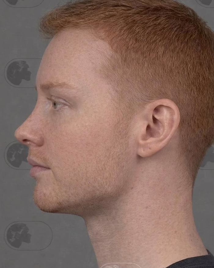 “Best Facial Harmonization I’ve Ever Seen”: 25 Before-And-Afters By A Plastic Surgeon Whose Work Went Viral