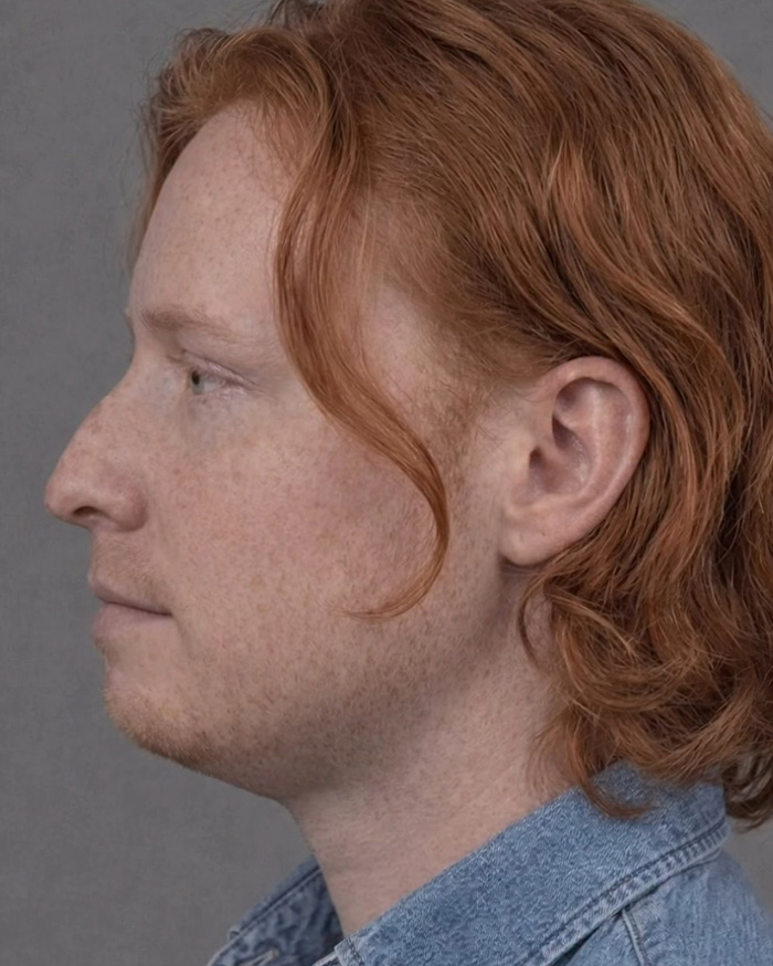 “Best Facial Harmonization I’ve Ever Seen”: 25 Before-And-Afters By A Plastic Surgeon Whose Work Went Viral