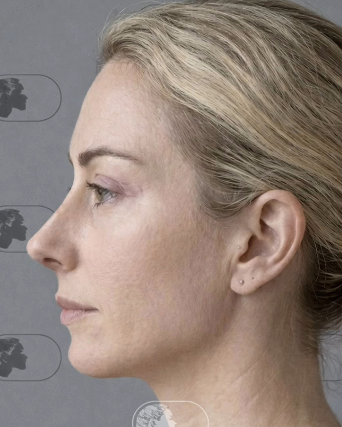 “Best Facial Harmonization I’ve Ever Seen”: 25 Before-And-Afters By A Plastic Surgeon Whose Work Went Viral