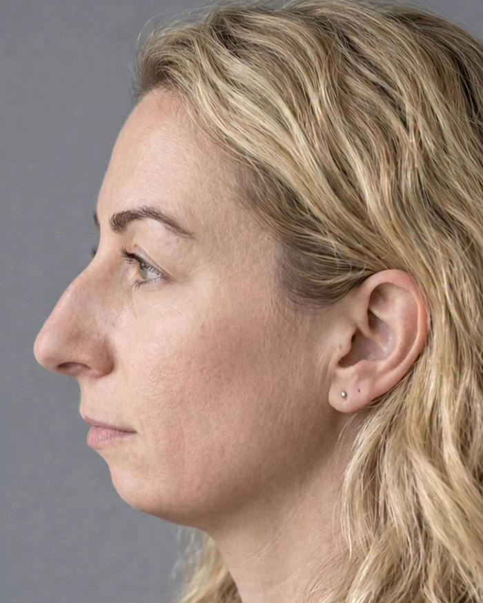 “Best Facial Harmonization I’ve Ever Seen”: 25 Before-And-Afters By A Plastic Surgeon Whose Work Went Viral