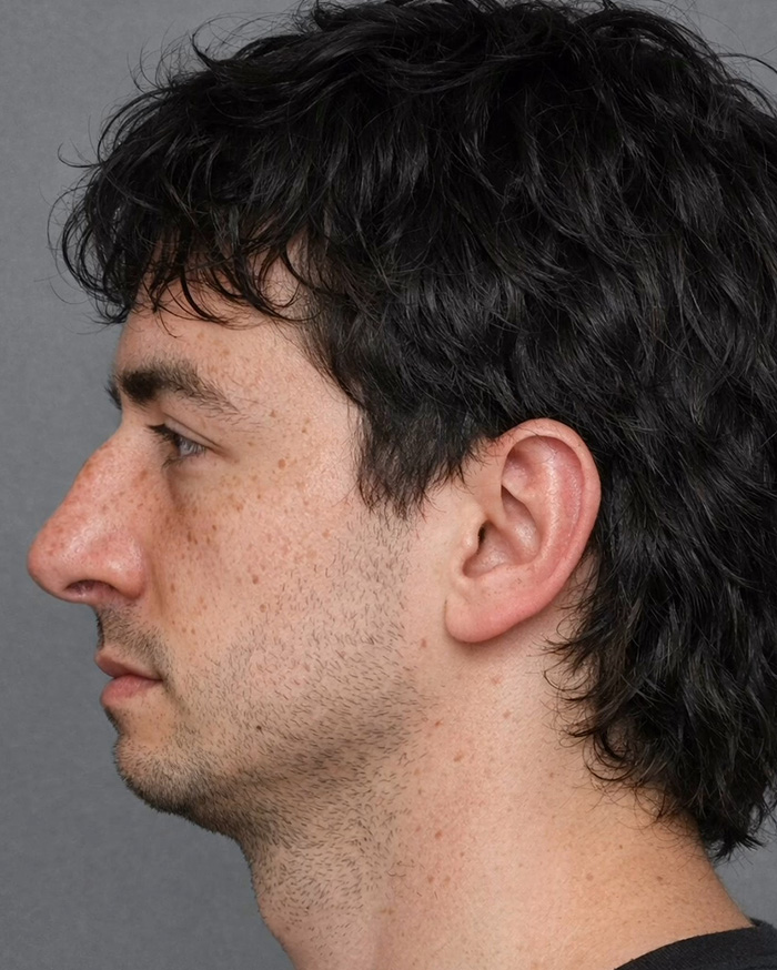 “Best Facial Harmonization I’ve Ever Seen”: 25 Before-And-Afters By A Plastic Surgeon Whose Work Went Viral