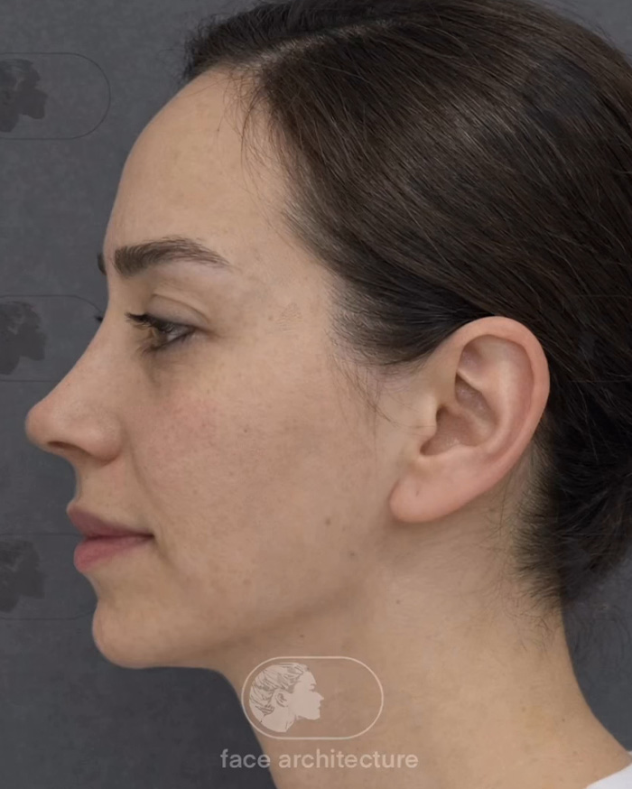 “Best Facial Harmonization I’ve Ever Seen”: 25 Before-And-Afters By A Plastic Surgeon Whose Work Went Viral