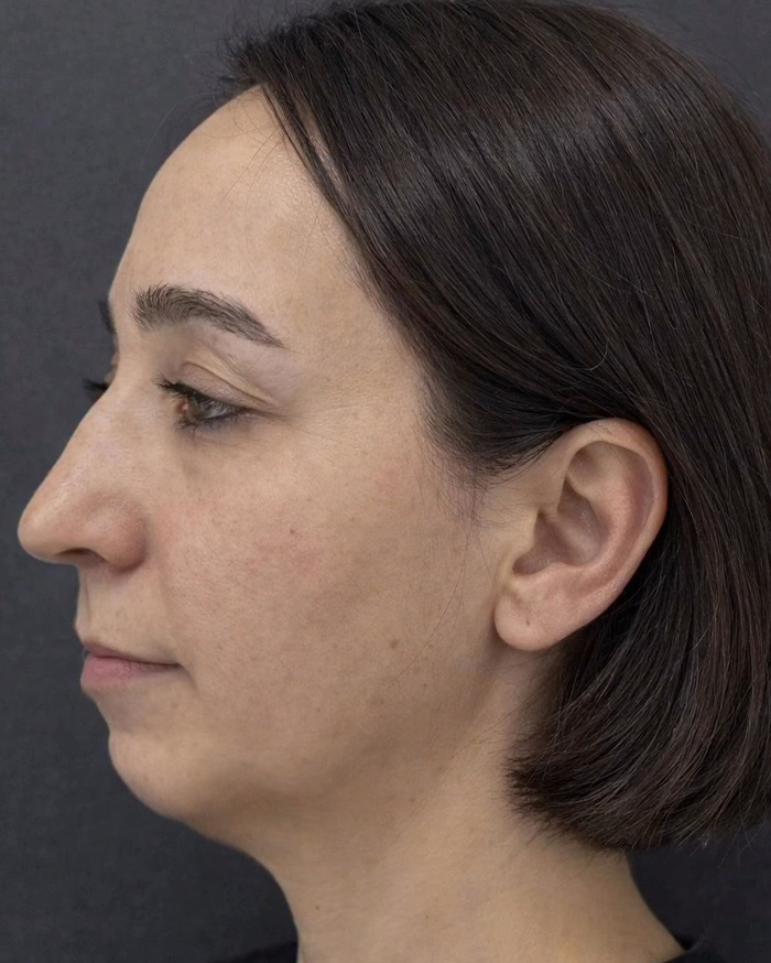 “Best Facial Harmonization I’ve Ever Seen”: 25 Before-And-Afters By A Plastic Surgeon Whose Work Went Viral