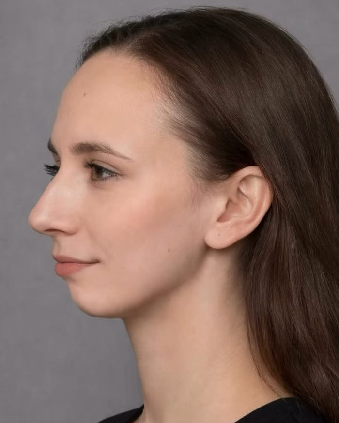 “Best Facial Harmonization I’ve Ever Seen”: 25 Before-And-Afters By A Plastic Surgeon Whose Work Went Viral