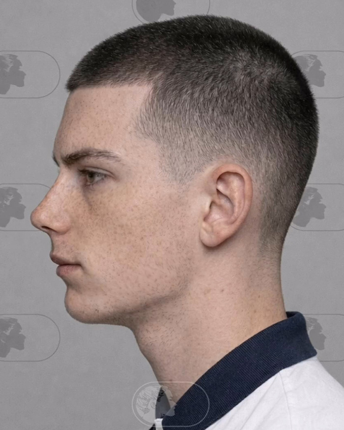 “Best Facial Harmonization I’ve Ever Seen”: 25 Before-And-Afters By A Plastic Surgeon Whose Work Went Viral