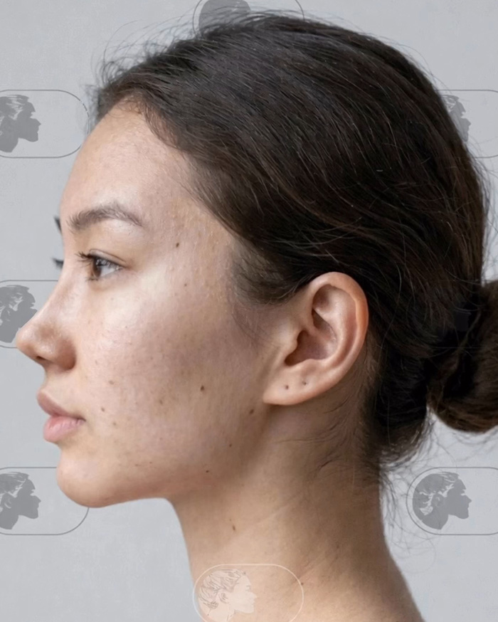 “Best Facial Harmonization I’ve Ever Seen”: 25 Before-And-Afters By A Plastic Surgeon Whose Work Went Viral