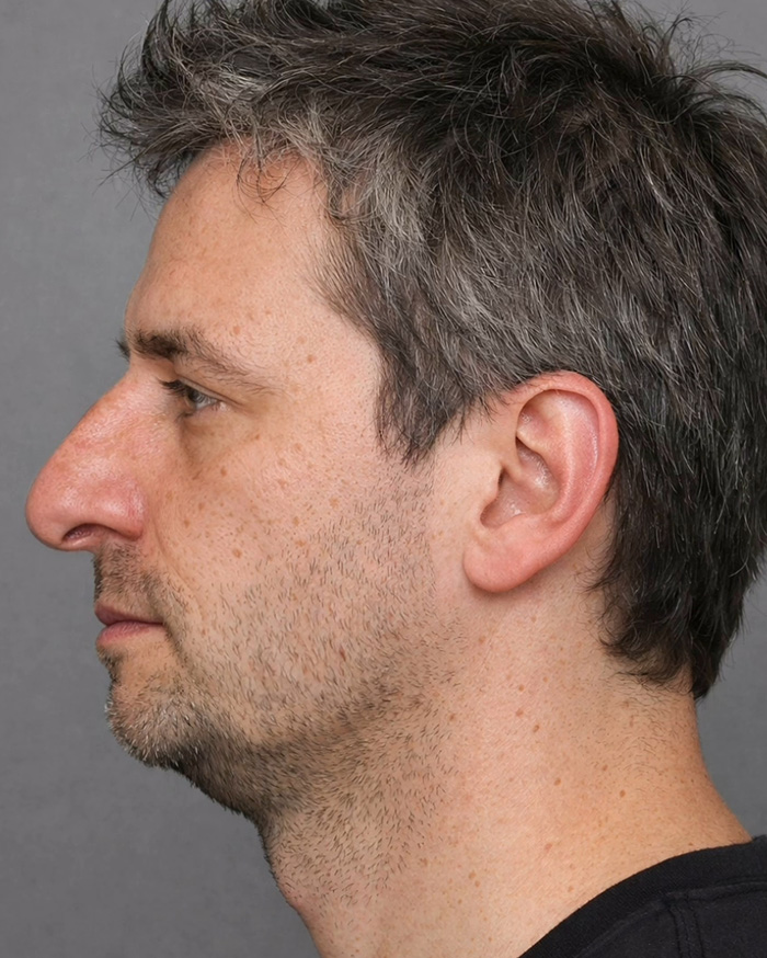 “Best Facial Harmonization I’ve Ever Seen”: 25 Before-And-Afters By A Plastic Surgeon Whose Work Went Viral