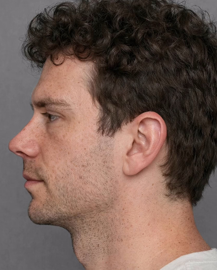 “Best Facial Harmonization I’ve Ever Seen”: 25 Before-And-Afters By A Plastic Surgeon Whose Work Went Viral