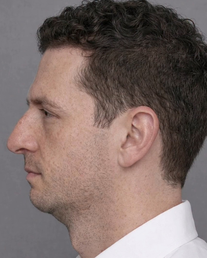 “Best Facial Harmonization I’ve Ever Seen”: 25 Before-And-Afters By A Plastic Surgeon Whose Work Went Viral