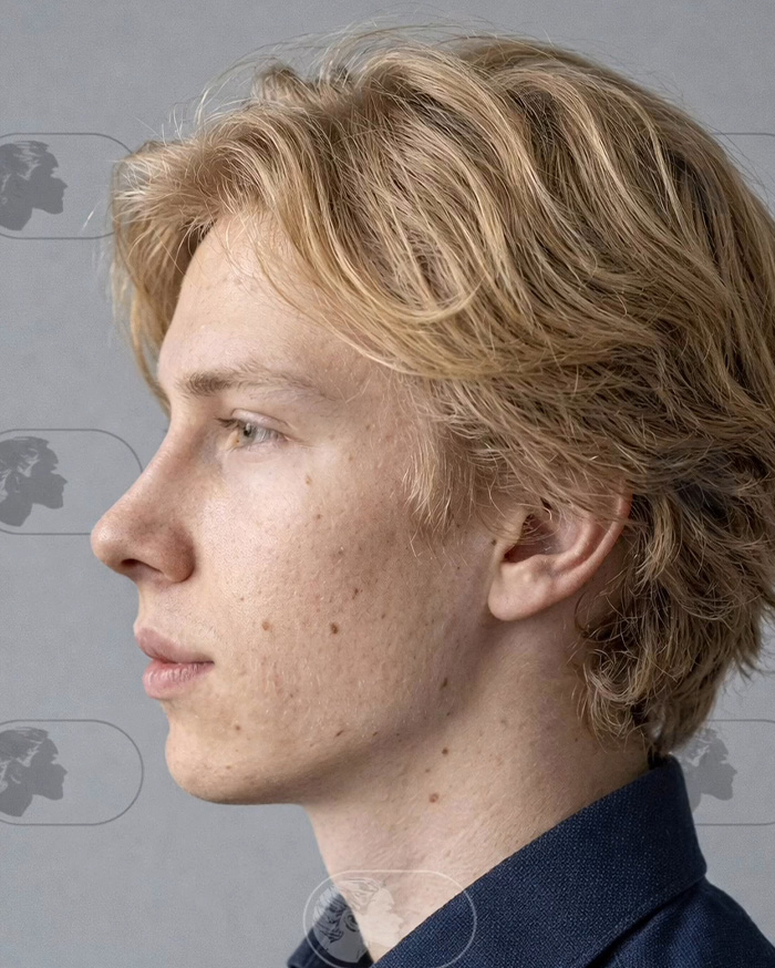 “Best Facial Harmonization I’ve Ever Seen”: 25 Before-And-Afters By A Plastic Surgeon Whose Work Went Viral