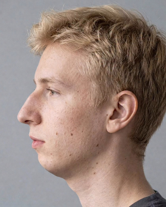 “Best Facial Harmonization I’ve Ever Seen”: 25 Before-And-Afters By A Plastic Surgeon Whose Work Went Viral