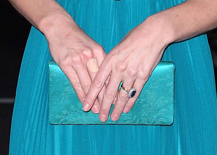 Kate Middleton’s Bandaged Hand For Late Queen Elizabeth’s Centenary Celebrations Sparks Speculation