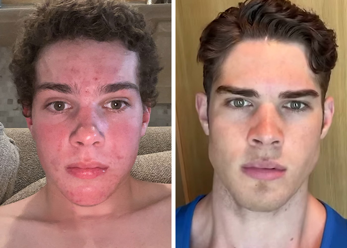 From Bone Smashing To Chin Extensions, Here Are Before-And-After Collages Of “Looksmaxxing” Influencers