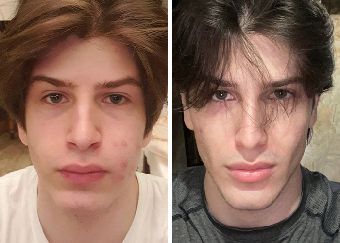From Bone Smashing To Chin Extensions, Here Are Before-And-After Collages Of “Looksmaxxing” Influencers