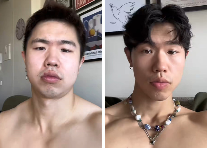 From Bone Smashing To Chin Extensions, Here Are Before-And-After Collages Of “Looksmaxxing” Influencers