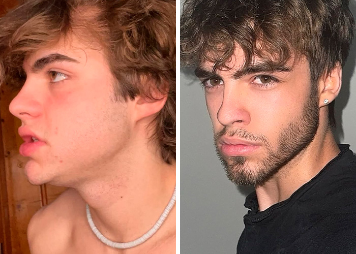 From Bone Smashing To Chin Extensions, Here Are Before-And-After Collages Of “Looksmaxxing” Influencers