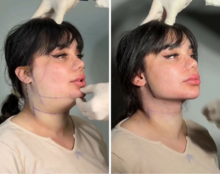 31 Impressive Jawline Transformations Shared On This Page Have People Doing A Double Take
