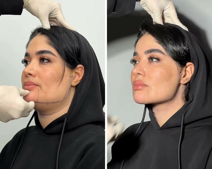 31 Impressive Jawline Transformations Shared On This Page Have People Doing A Double Take