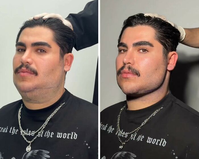 31 Impressive Jawline Transformations Shared On This Page Have People Doing A Double Take